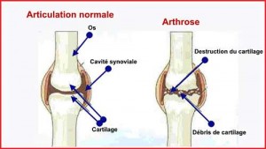 Articulation normale et articulation souffrant d'arthrose